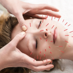 Acupuncture on face