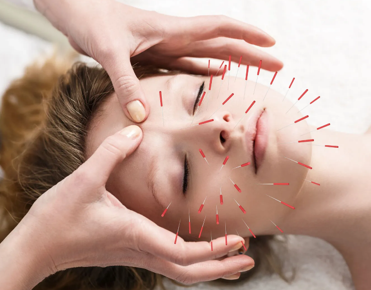 Acupuncture on face